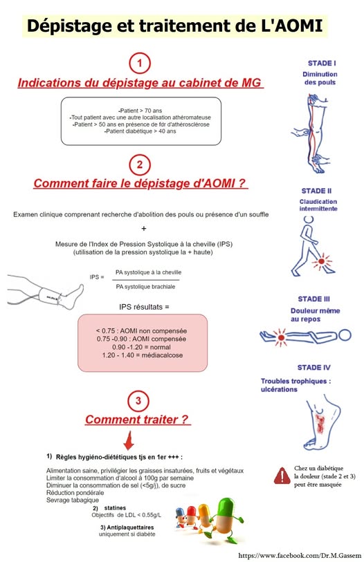Dépistage et traitement de AOMI